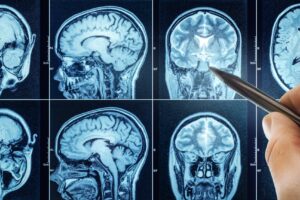 Is the Depo Shot Linked to Brain Tumors?